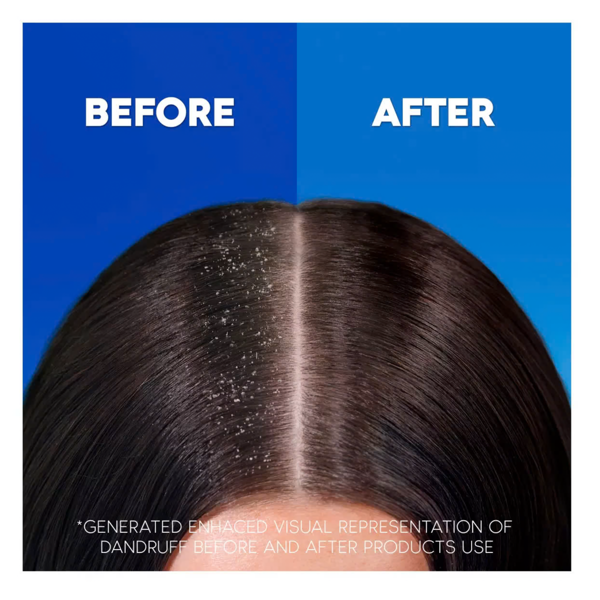 Head & Shoulders Classic Clean Anti-Dandruff Shampoo, 1000ml, up to 100% Flake-Free, 1 x 1L by Betaglam